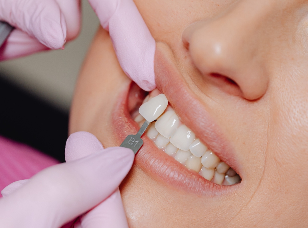 Imagem do post: Quanto tempo duram as lentes de porcelana? Tudo que você precisa saber sobre durabilidade