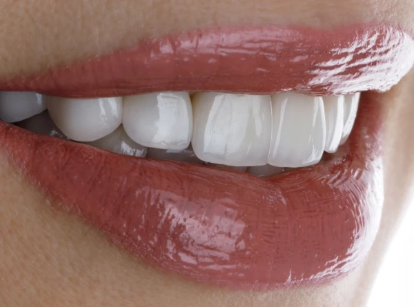Lentes dentais deixam o sorriso com aparência artificial? A verdade sobre naturalidade